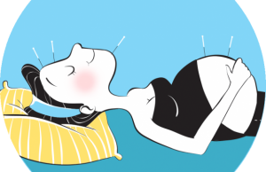 acupuncture