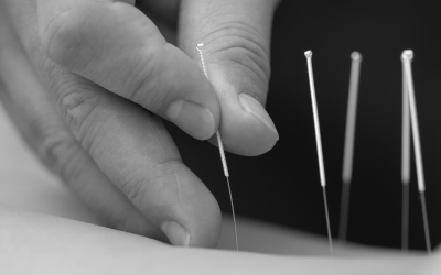 Notre sage-femme vous répond : pour préparer le col à l’accouchement, est-il judicieux de faire des séances d’acupuncture ?