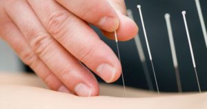 acupuncture